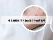 牛皮癣视频 耳背放血治疗牛皮癣视频