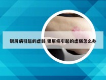 银屑病引起的虚弱 银屑病引起的虚弱怎么办