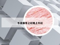 牛皮癣早上红晚上不红