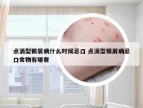 点滴型银屑病什么时候忌口 点滴型银屑病忌口食物有哪些