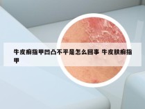 牛皮癣指甲凹凸不平是怎么回事 牛皮肤癣指甲