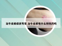 治牛皮癣症状专家 治牛皮癣有什么特效药吗