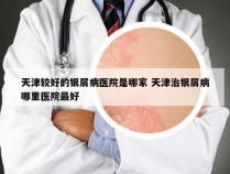 天津较好的银屑病医院是哪家 天津治银屑病哪里医院最好
