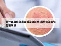 为什么扁桃体发炎引发银屑病 扁桃体发炎引起银屑病