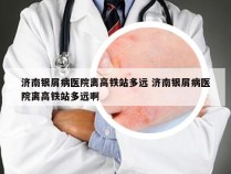 济南银屑病医院离高铁站多远 济南银屑病医院离高铁站多远啊