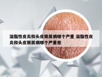 溢脂性皮炎和头皮银屑病哪个严重 溢脂性皮炎和头皮银屑病哪个严重些