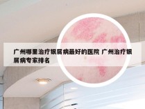 广州哪里治疗银屑病最好的医院 广州治疗银屑病专家排名