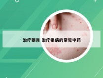 治疗银肖 治疗银病的常见中药