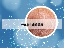 什么治牛皮癣管用