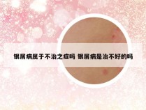 银屑病属于不治之症吗 银屑病是治不好的吗