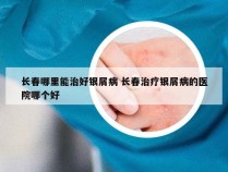 长春哪里能治好银屑病 长春治疗银屑病的医院哪个好