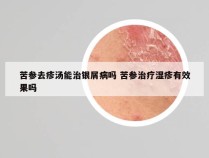 苦参去疹汤能治银屑病吗 苦参治疗湿疹有效果吗