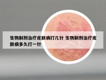 生物制剂治疗皮肤病打几针 生物制剂治疗皮肤病多久打一针