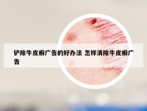 铲除牛皮癣广告的好办法 怎样清除牛皮癣广告