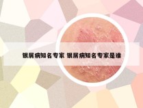 银屑病知名专家 银屑病知名专家是谁