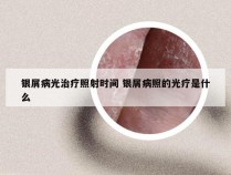 银屑病光治疗照射时间 银屑病照的光疗是什么