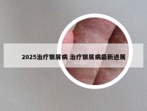 2025治疗银屑病 治疗银屑病最新进展