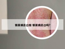 银屑病忌口烟 银屑病忌口吗?