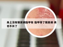 身上没有银屑病指甲有 指甲得了银屑病 再也不长了