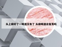头上癣好了一喝酒又有了 头癣喝酒会复发吗