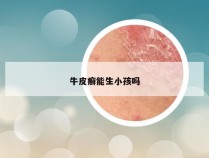 牛皮癣能生小孩吗