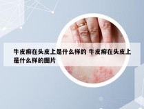 牛皮癣在头皮上是什么样的 牛皮癣在头皮上是什么样的图片