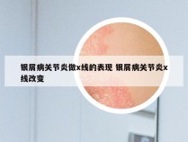 银屑病关节炎做x线的表现 银屑病关节炎x线改变