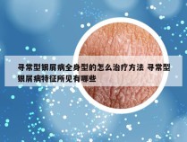 寻常型银屑病全身型的怎么治疗方法 寻常型银屑病特征所见有哪些