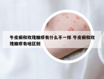 牛皮癣和玫瑰糠疹有什么不一样 牛皮癣和玫瑰糠疹有啥区别