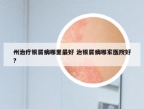 州治疗银屑病哪里最好 治银屑病哪家医院好?