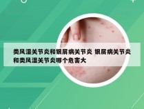 类风湿关节炎和银屑病关节炎 银屑病关节炎和类风湿关节炎哪个危害大