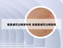 银屑病可以喝茶叶吗 有银屑病可以喝茶吗