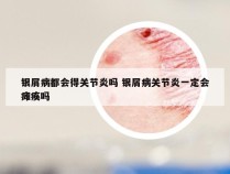 银屑病都会得关节炎吗 银屑病关节炎一定会瘫痪吗