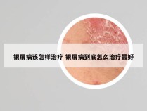 银屑病该怎样治疗 银屑病到底怎么治疗最好