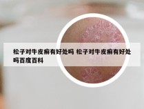 松子对牛皮癣有好处吗 松子对牛皮癣有好处吗百度百科