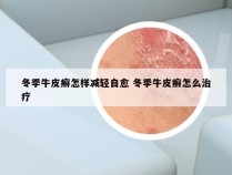 冬季牛皮癣怎样减轻自愈 冬季牛皮癣怎么治疗