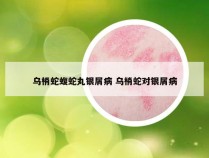 乌梢蛇蝮蛇丸银屑病 乌梢蛇对银屑病