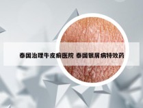 泰国治理牛皮癣医院 泰国银屑病特效药