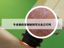 牛皮癣的生物制剂可以自己打吗