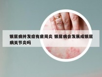 银屑病并发症有肩周炎 银屑病会发展成银屑病关节炎吗