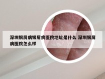 深圳银屑病银屑病医院地址是什么 深圳银屑病医院怎么样