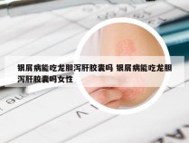 银屑病能吃龙胆泻肝胶囊吗 银屑病能吃龙胆泻肝胶囊吗女性
