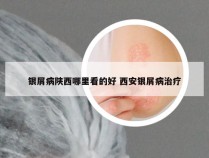 银屑病陕西哪里看的好 西安银屑病治疗