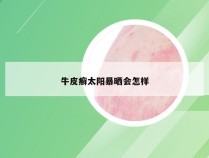 牛皮癣太阳暴晒会怎样