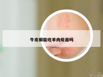 牛皮癣能吃羊肉烩面吗