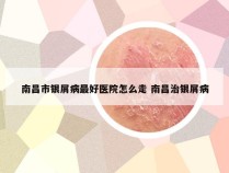 南昌市银屑病最好医院怎么走 南昌治银屑病