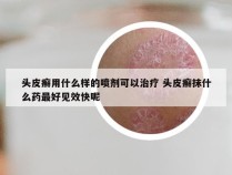 头皮癣用什么样的喷剂可以治疗 头皮癣抹什么药最好见效快呢