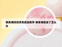银屑病找到诱发感染概率 银屑病感染了怎么办