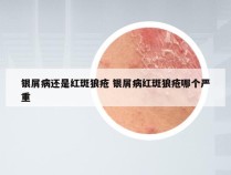 银屑病还是红斑狼疮 银屑病红斑狼疮哪个严重