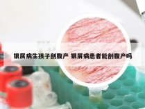 银屑病生孩子剖腹产 银屑病患者能剖腹产吗